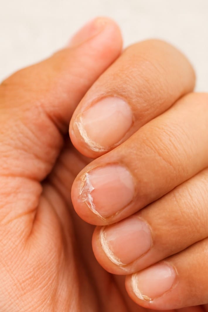 Neuredni nokti - nokti na ruci se listaju